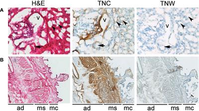 Tenascin-W Is a Novel Stromal Marker in Biliary Tract Cancers